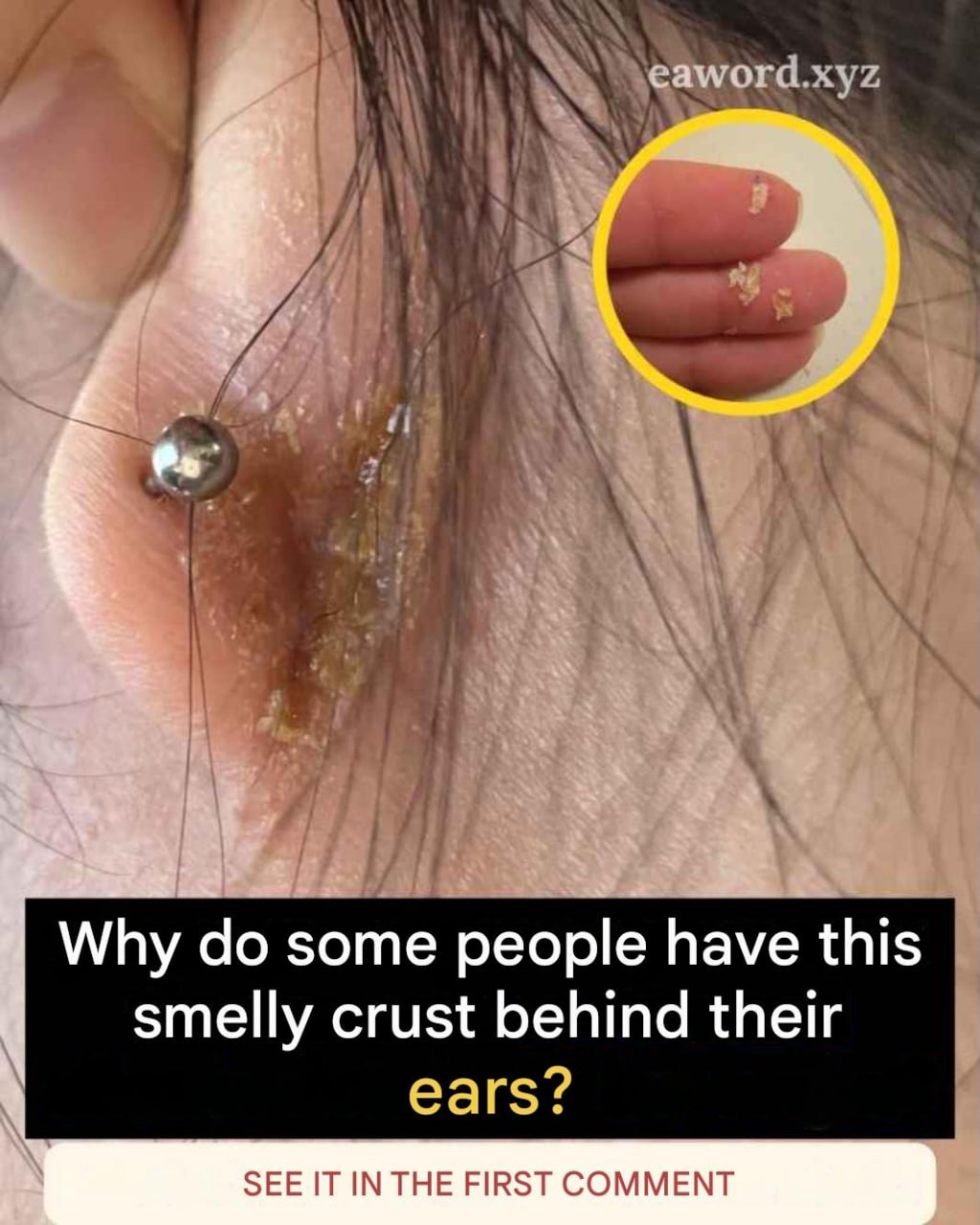 If you have scabs behind your ears, it definitely means you have…See More